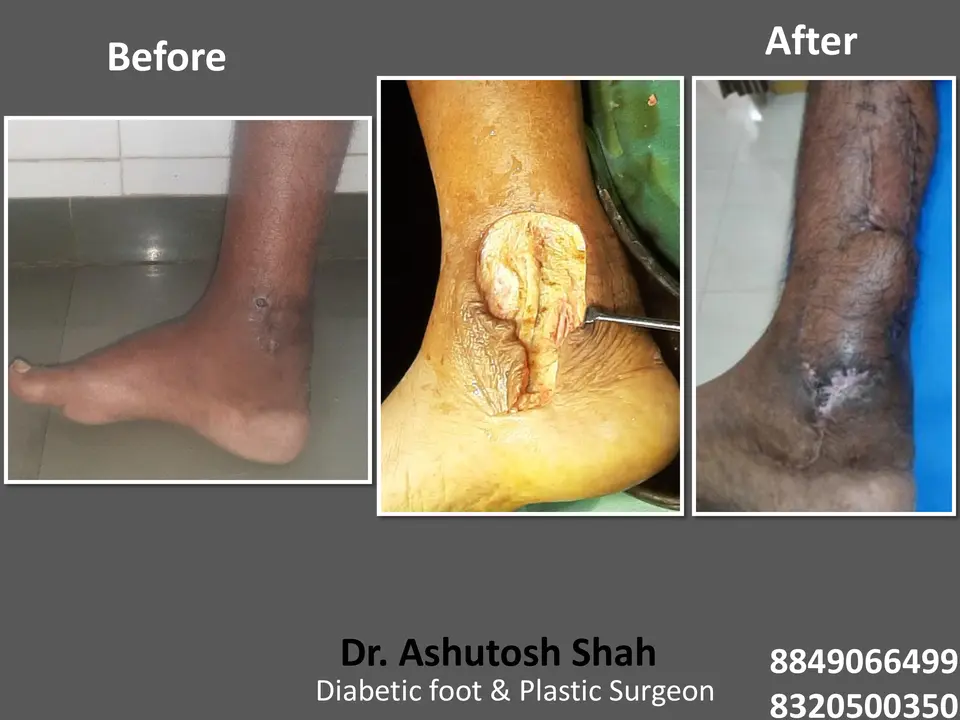 Diabetic Foot  PPT sunita.pptx-59.webp